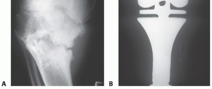 صورة طبية: تجنب الجراحة الكبرى: علاج أورام العظام بالنيتروجين السائل بتقنية الصب المباشر