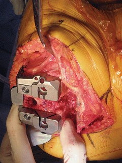 Illustration 36 for Posterior Stabilized Technique: Essential Insights for TKA Success