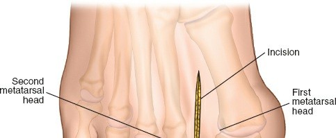 Mastering the Dorsolateral Approach for Bunion Surgery