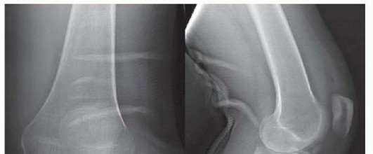 Mastering Posterior Plateau Fractures via Direct Posterior Approaches