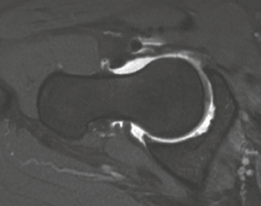 Illustration 5 for Beyond Arthroscopy: Surgical Hip Dislocation for Complex Instability