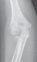 كسر عنق الكعبرة لدى الأطفال والكبار: دليلك الشامل للتشخيص والعلاج والتعافي في اليمن