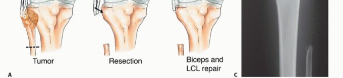 صورة طبية: استئصال أورام الشظية: دليل شامل للعلاج الحديث والحفاظ على الأطراف مع الأستاذ الدكتور محمد هطيف