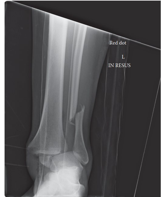 Ankle Fracture Case: Expert Guide to This Complex Case