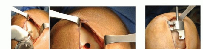 Illustration 5 for Unicondylar Knee Arthroplasty: Is This Your Solution to Knee Pain?