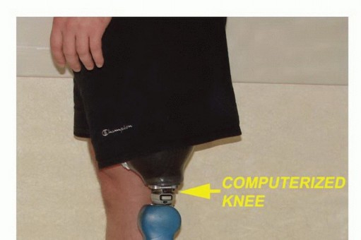 صورة توضيحية لـ بتر فوق الركبة: دليل شامل للمرضى وخيارات التعافي مع الأستاذ الدكتور محمد هطيف