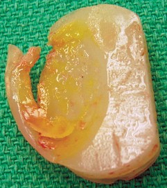 Illustration 19 for Revision of Failed UKA: Your Guide to Successful Treatment