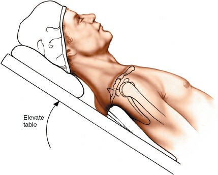 Proximal Humerus Lateral Approach: Unlock Surgical Precision