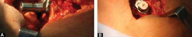 صورة طبية: مفصل الفخذ الصناعي قصير الجذع METHA: حلول مبتكرة للحفاظ على العظم في صنعاء مع الأستاذ الدكتور محمد هطيف