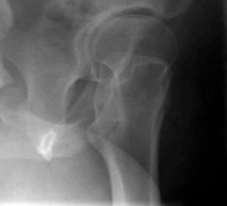 Illustration 4 for Periacetabular Osteotomy: End Hip Pain, Improve Flexion and Internal Motion