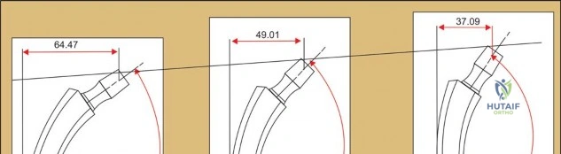 Illustration 4 for Nanos Neck Preserving THA