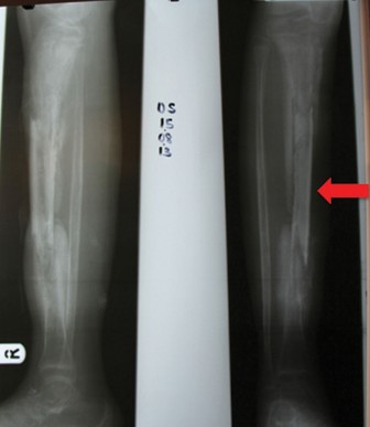 Pediatric Osteomyelitis: What Kids Are Likely to Need Prompt Evaluation