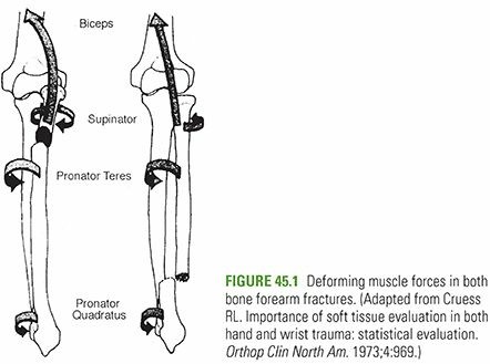 Pediatric Forearm Fractures: Your Guide to Long Arm Casts