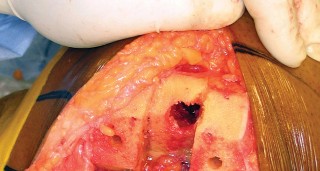 Illustration 8 for Monoblock Total Knee: When to Use & What to Avoid