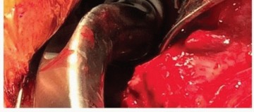 صورة طبية: تثبيت مفصل الورك بدون أسمنت: دليل شامل لمرضى استبدال الورك مع الأستاذ الدكتور محمد هطيف