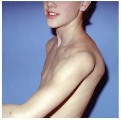 وداعاً لألم الكتف المتكرر: دليلك الشامل لعلاج عدم استقرار الكتف الخلفي واستعادة حياتك في اليمن