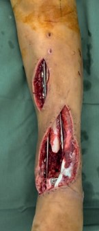 Illustration 31 for Decoding Pilon Fractures: Anterolateral and Medial Fragments Revealed