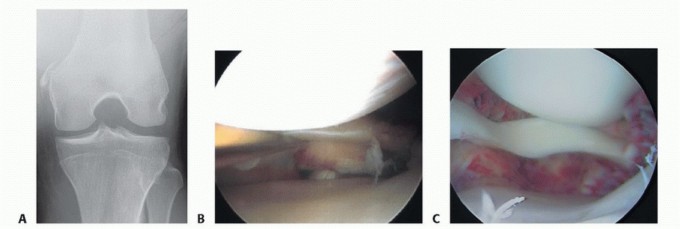 Repair & Recover from Collateral Ligament Injuries: Your Guide