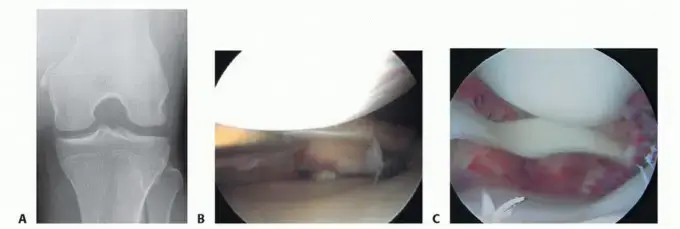 صورة توضيحية لـ إصابة الرباط الجانبي الإنسي (MCL) في الركبة: دليل المريض الشامل للتعافي