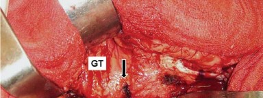 Illustration 6 for Mastering Soft Tissue Balancing for Optimal THR Outcomes
