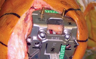 Illustration 29 for Minimize Pain, Maximize Recovery: TKA with Parapatellar