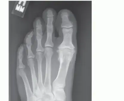 صورة توضيحية لـ إبهام القدم المتيبس (Hallux Rigidus): دليلك الشامل لآلام المفصل وطرق علاجه المتقدمة مع الأستاذ الدكتور محمد هطيف