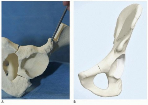 Illustration 23 for Periacetabular Osteotomy: Realigning your hip via the superior pubic ramus