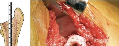 توضيح طبي: استبدال مفصل الورك الكلي بتقنية الإسمنت للفخذ: دليلك الشامل لنتائج تدوم طويلاً مع الأستاذ الدكتور محمد هطيف في صنعاء