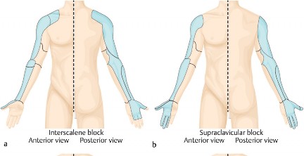 Illustration of shoulder surgery perioperative - Dr. Mohammed Hutaif