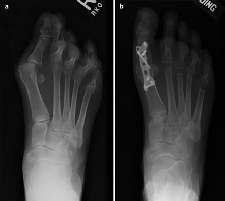 Illustration 98 for First Metatarsal Surgery: Expert Solutions for Foot & Ankle Pain