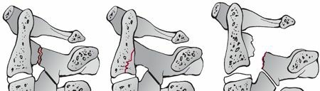 Understanding C2 Lateral Mass Fractures: Diagnosis & Treatment