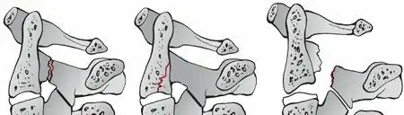 صورة توضيحية لـ كسور الفقرة العنقية الثانية (C2): الدليل الشامل للمرضى مع الأستاذ الدكتور محمد هطيف