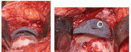 Illustration of uncemented acetabular component - Dr. Mohammed Hutaif