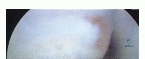 صورة توضيحية لـ تمزق وتر أخيل (العرقوب): دليلك الشامل للتشخيص، العلاج، والتعافي في اليمن مع الأستاذ الدكتور محمد هطيف
