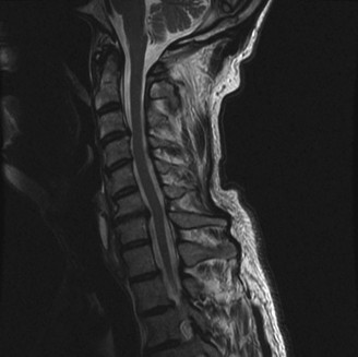 Illustration 2 for Adjacent Segment Degeneration: Your Next Spine Case Solved