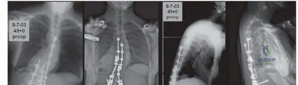 صورة توضيحية لـ جراحة طرح الفقرة وتصحيح الحداب: دليل شامل للمرضى مع الأستاذ الدكتور محمد هطيف