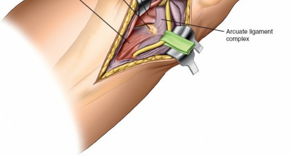 Figure 11: Deep dissection exposing the soleus muscle and its separation from the gastrocnemius.