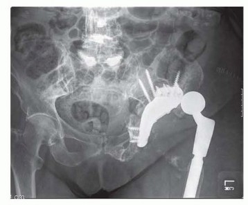 Illustration 16 for Pelvic Discontinuity: Understanding Superior and Inferior Separation