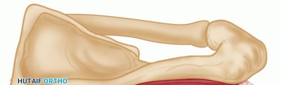 Illustration 13 for Finally Treat Recurrent Posterior Instability of the Shoulder