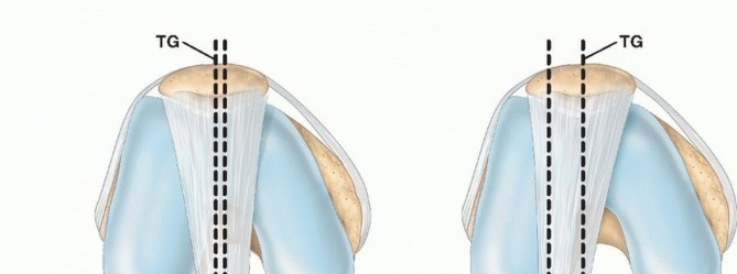 Illustration of tibial tubercle transfer - Dr. Mohammed Hutaif