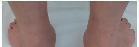 صورة توضيحية لـ جراحة إطالة العمود الوحشي: الحل الفعّال لعلاج القدم المسطحة المؤلمة