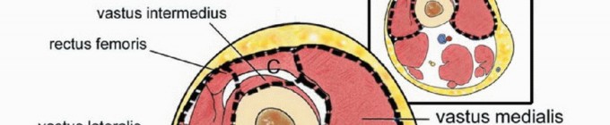 صورة توضيحية لـ استئصال ساركوما العضلة الرباعية مع الحفاظ على الطرف: دليل شامل للمرضى مع الأستاذ الدكتور محمد هطيف في صنعاء