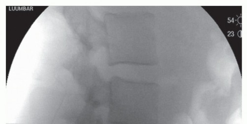 End Lumbar Spinal Stenosis Pain with Minimally Invasive Laminectomy