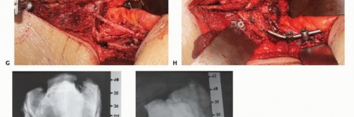 صورة طبية: جراحة أورام العجز: الحفاظ على وظائف الأمعاء والمثانة مع الأستاذ الدكتور محمد هطيف في صنعاء