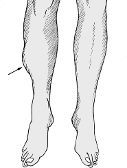 Sudden Calf Pain? Could It Be a Ruptured Plantaris Tendon?