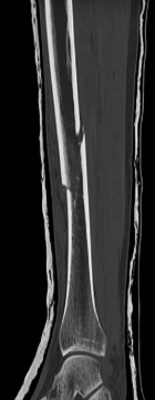 Illustration 7 for Tibial Fracture Extending into the Plafond: Intramedullary Secrets