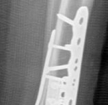 Illustration 28 for Decoding Pilon Fractures: Anterolateral and Medial Fragments Revealed