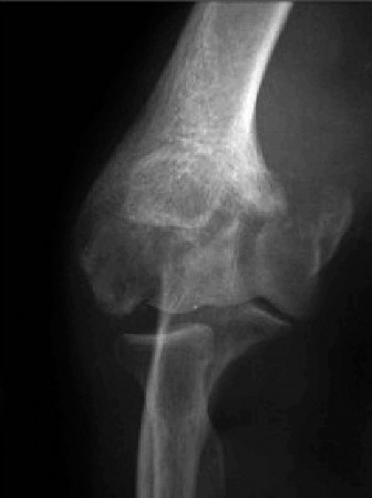 Illustration 86 for Right Shoulder Pain? Avoid This Common X-ray Mistake.