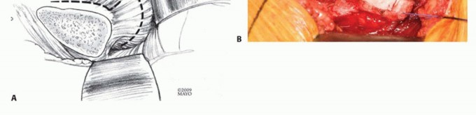 Illustration 10 for Surgical Hip Dislocation Safety: The Branch of the MFCA's Vital Role