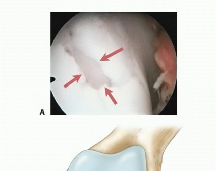 Illustration of microfracture chondroplasty microfracture - Dr. Mohammed Hutaif